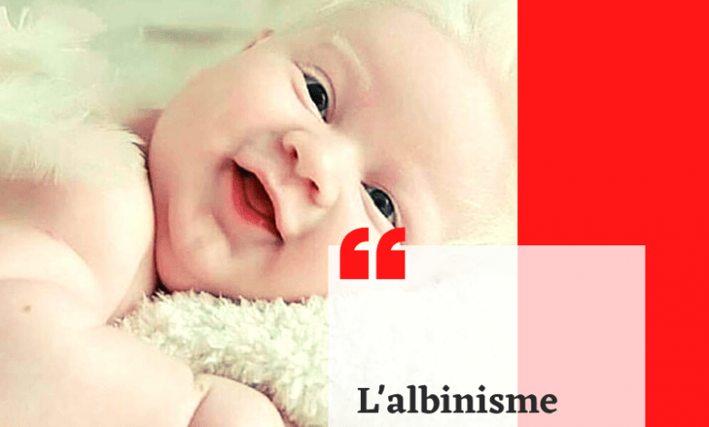 Photo of L’albinisme