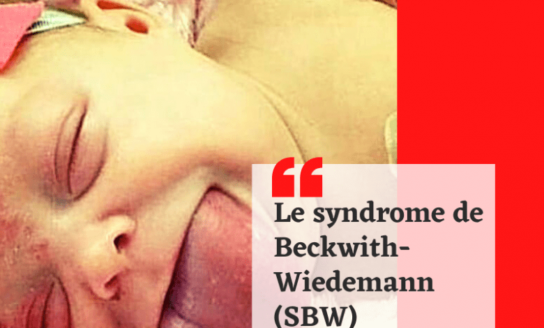Photo of Le syndrome de Beckwith-Wiedemann (SBW)