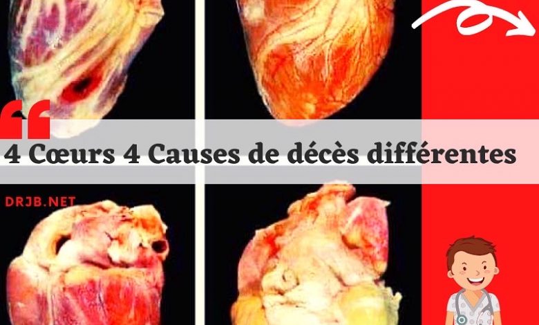 Photo of 4 Cœurs 4 Causes de décès différentes