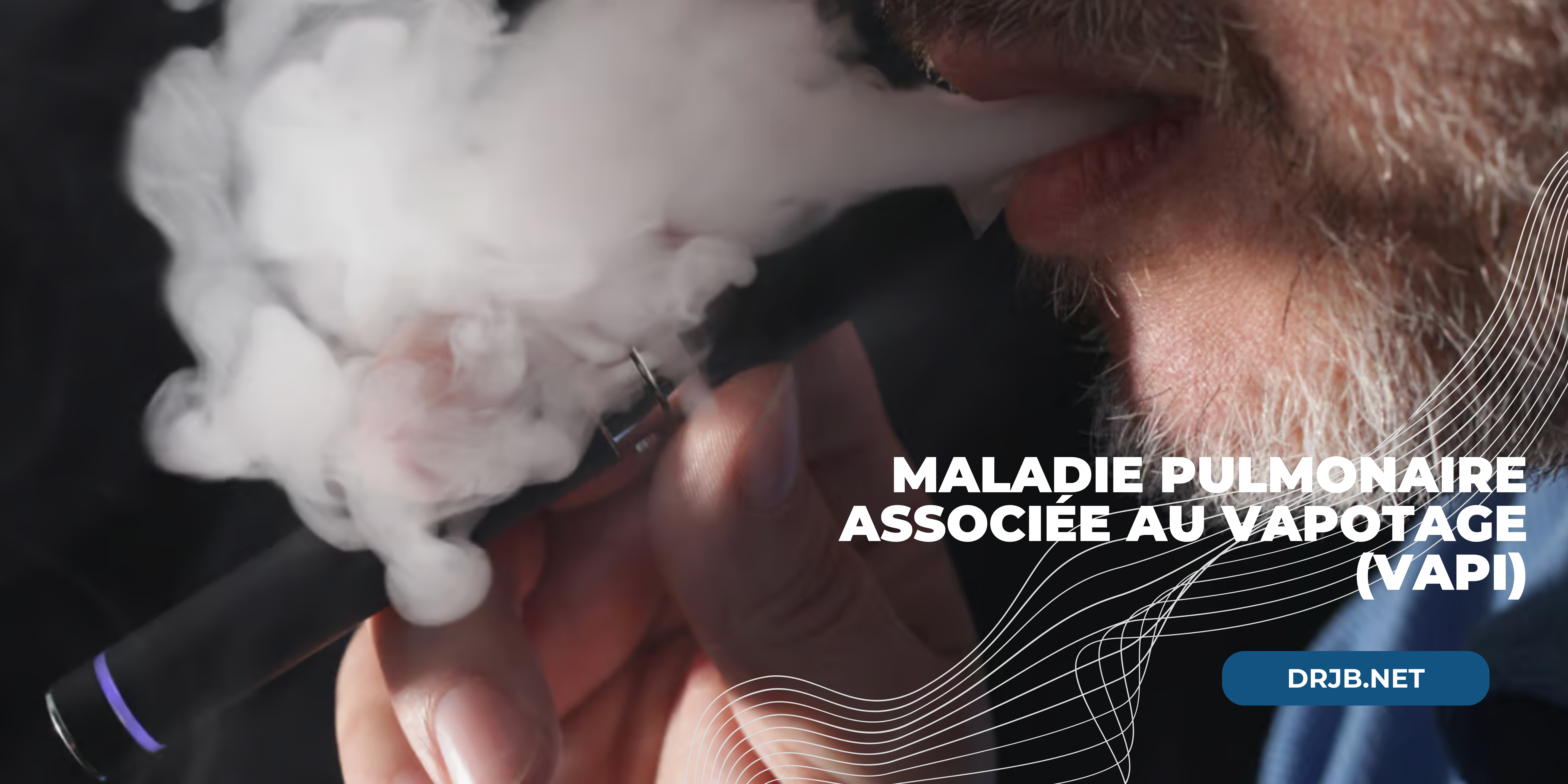 Maladie pulmonaire associée au vapotage (VAPI)